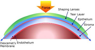 Orthokeratology Shaping Lens