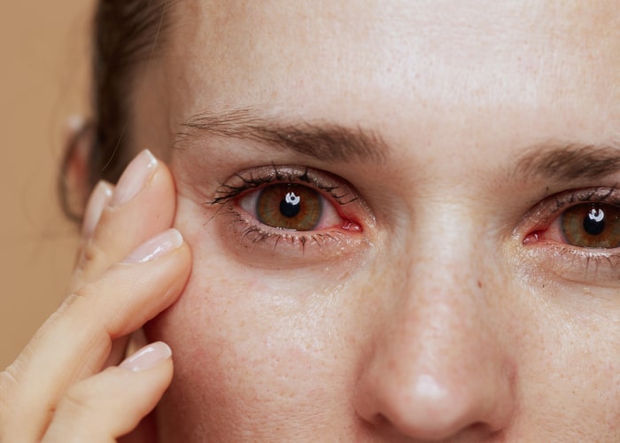 Causes of dry eye