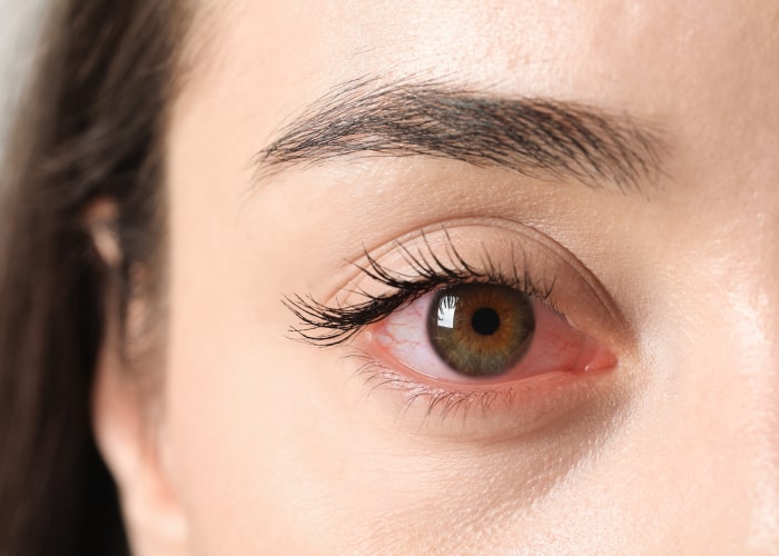 Painful red eye